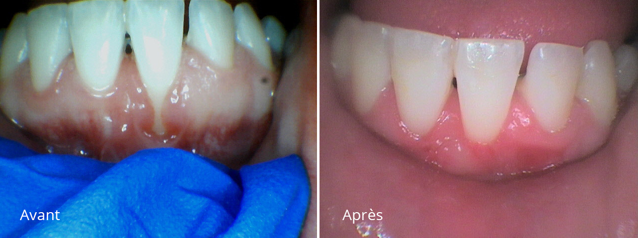 Greffe Gingivale